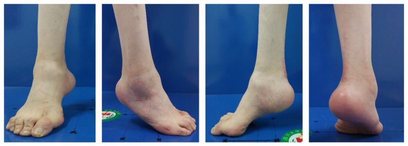 Four views of a unilateral calcaneocavus deformity showing a high arch, prominent heel and elevated calcaneal pitch