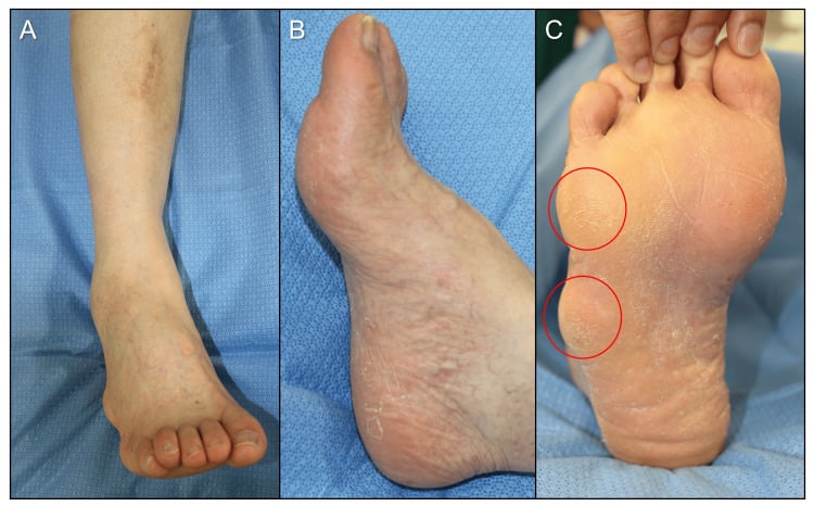 Frontal, lateral and plantar photographs of a cavovarus foot with callosities circled beneath the first and fifth metatarsal heads