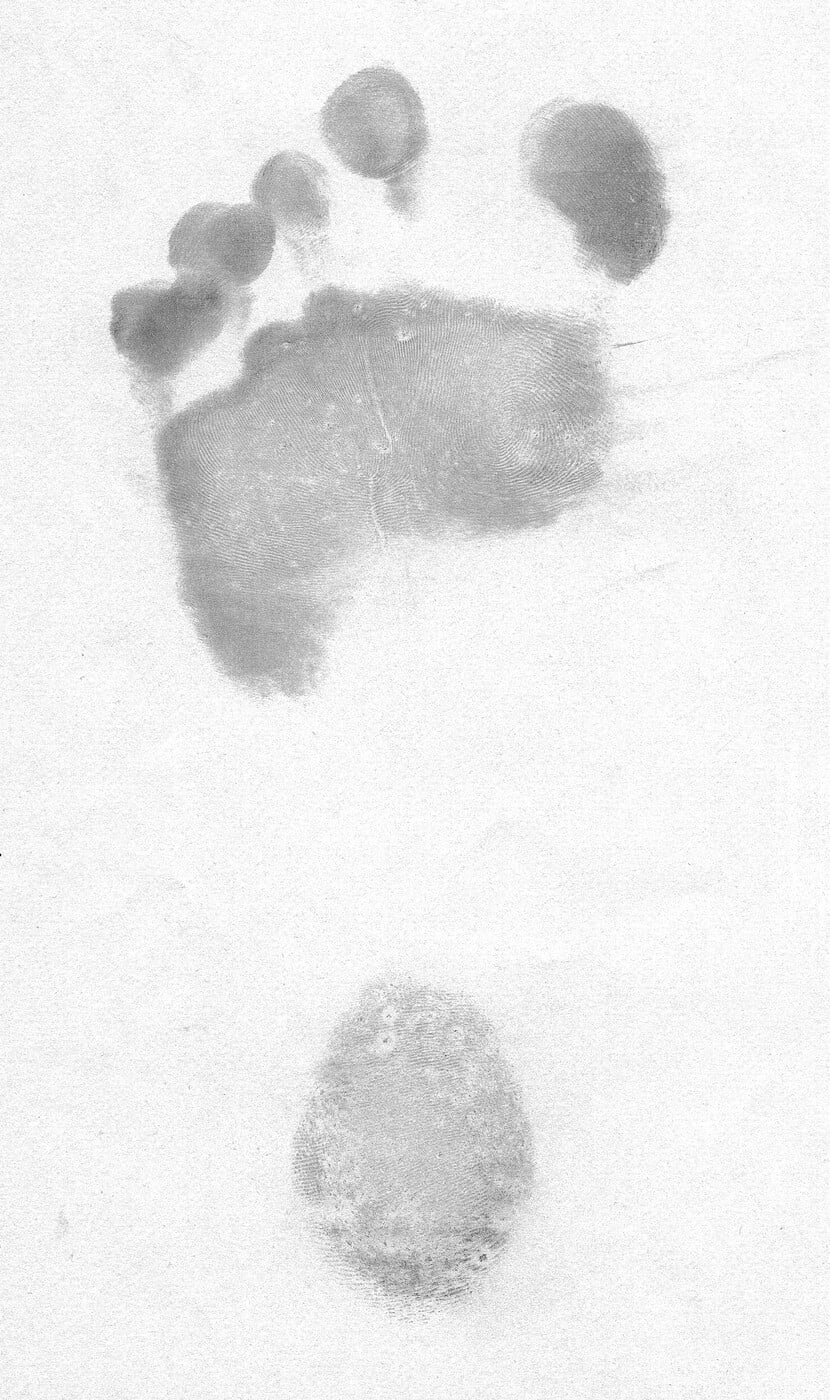 Footprint of a pes cavus foot showing an absent midfoot band between the forefoot and heel.