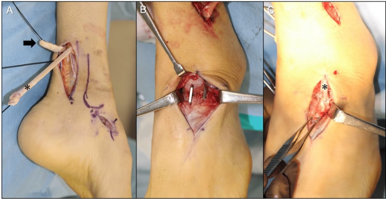 Intraoperative photographs showing the tibialis posterior tendon delivered retrograde, the talar neck after osteotomy and the tendon fixed to the lateral navicular