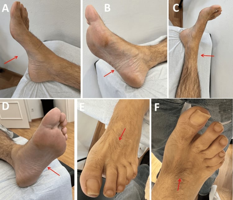 Photographs of both lower limbs showing wasting of the intrinsic foot muscles and distal calf with a high medial arch and clawing of the toes