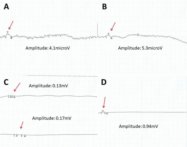 Nerve conduction study traces from median sensory, peroneal motor and tibial motor nerves showing markedly reduced amplitudes