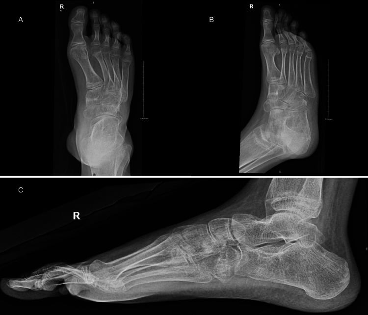 Anteroposterior, lateral and oblique radiographs four months after surgery showing recurrent cavovarus deformity with healed osteotomy sites and metatarsal overlap