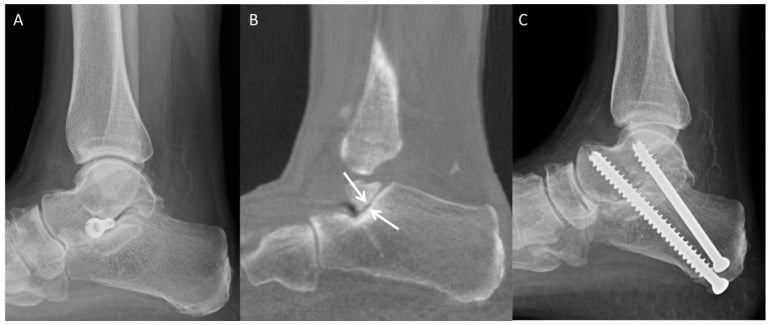 Radiograph, weightbearing CT and postoperative film showing accelerated posterior subtalar facet degeneration after an implant, treated by removal and subtalar arthrodesis