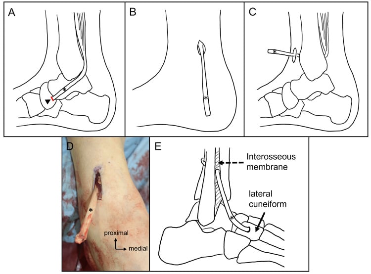 Five-panel sequence of tibialis posterior tendon transfer showing release at the navicular, retrograde delivery above the medial malleolus, passage through the interosseous membrane and fixation to the lateral cuneiform