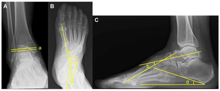 Weightbearing anteroposterior ankle, anteroposterior foot and lateral foot radiographs annotated with talar tilt, talo-first metatarsal, talocalcaneal and calcaneal pitch angles