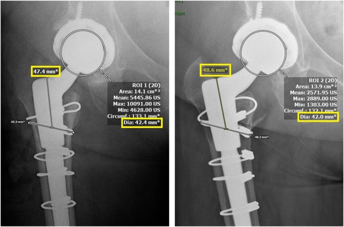 Serial anteroposterior radiographs illustrating measurement of femoral stem subsidence.