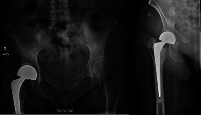 Postoperative pelvis and hip radiographs showing a cemented stem with complete canal fill.