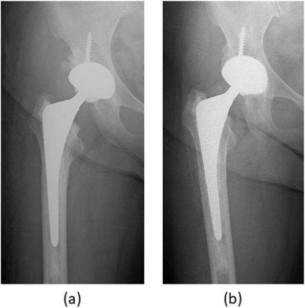 Immediate and ten-year radiographs of a line-to-line cemented polished stem without measurable subsidence.