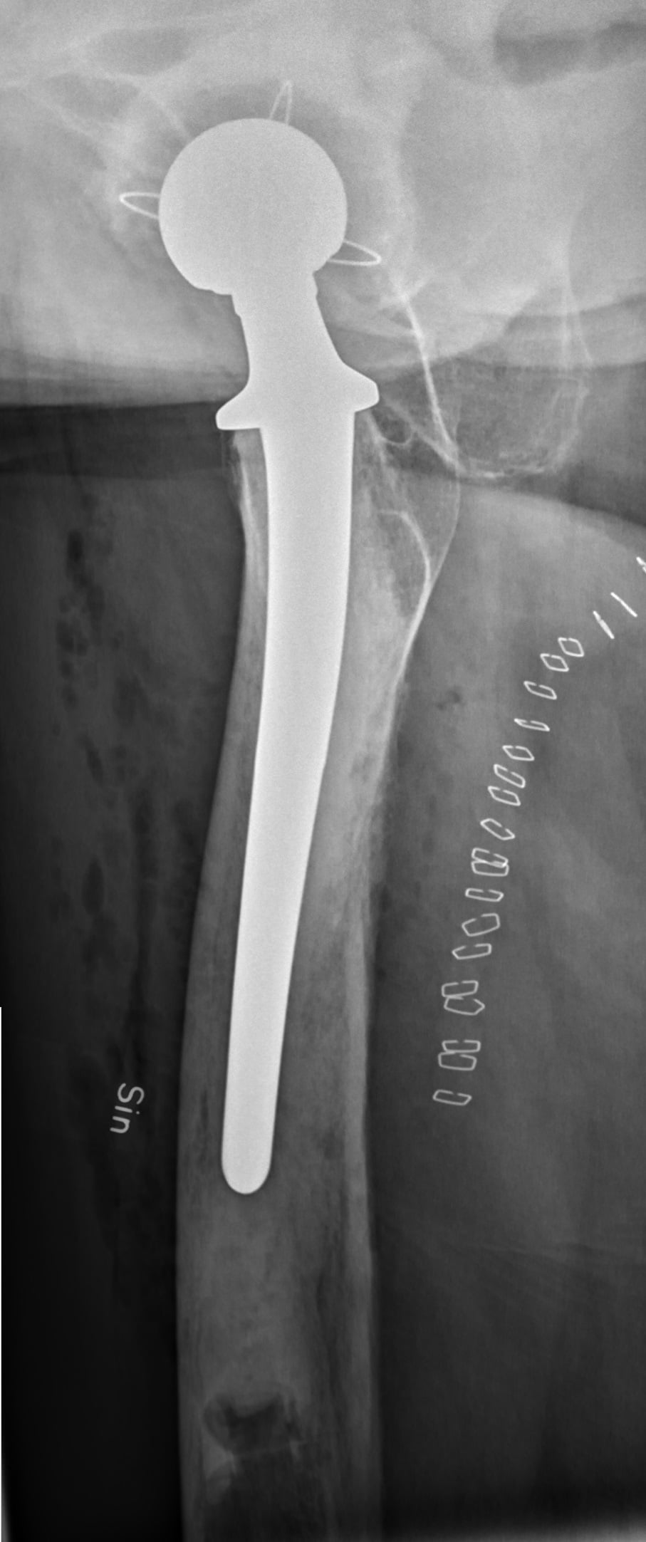 Lateral radiograph of a cemented femoral stem within its cement mantle.