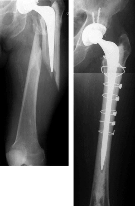 Radiograph of a long cemented revision stem and cables spanning a Vancouver B2 periprosthetic femoral fracture.