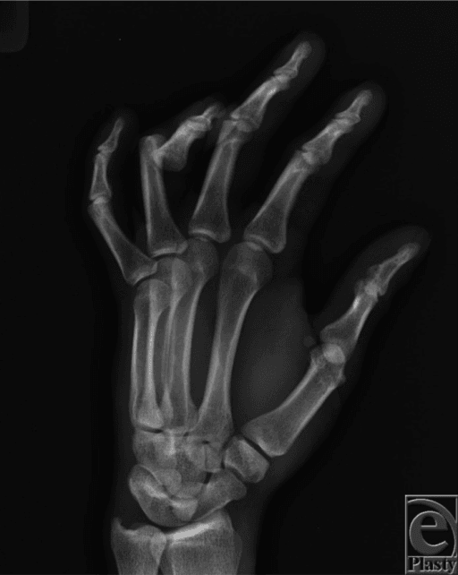 Oblique hand radiograph showing volar dislocation of the ring finger PIP joint