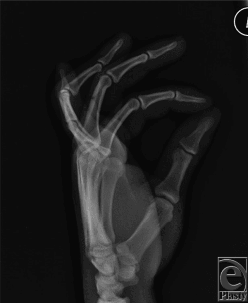 Oblique hand radiograph demonstrating boutonnière deformity