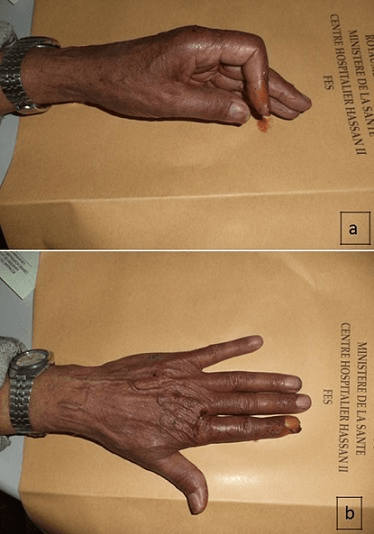Clinical photographs demonstrating boutonniere deformity of index finger