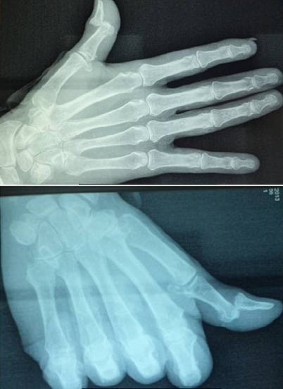 AP and lateral radiographs demonstrating PIP dislocation and dorsal middle phalanx base avulsion fracture