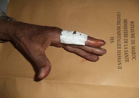 Finger extension splint orthosis for central slip avulsion