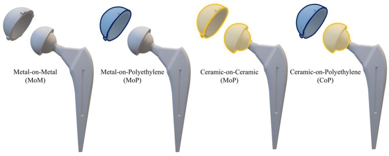 Schematic comparison of metal-on-metal, metal-on-polyethylene, ceramic-on-ceramic and ceramic-on-polyethylene total hip arthroplasty bearing surfaces