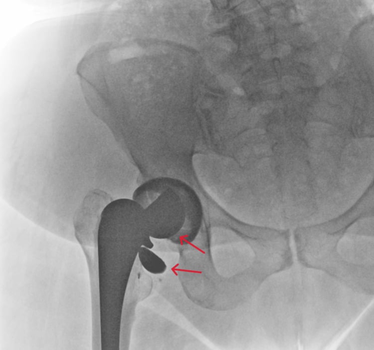 Anteroposterior pelvic radiograph showing a fractured ceramic femoral head with radiopaque fragments marked by arrows