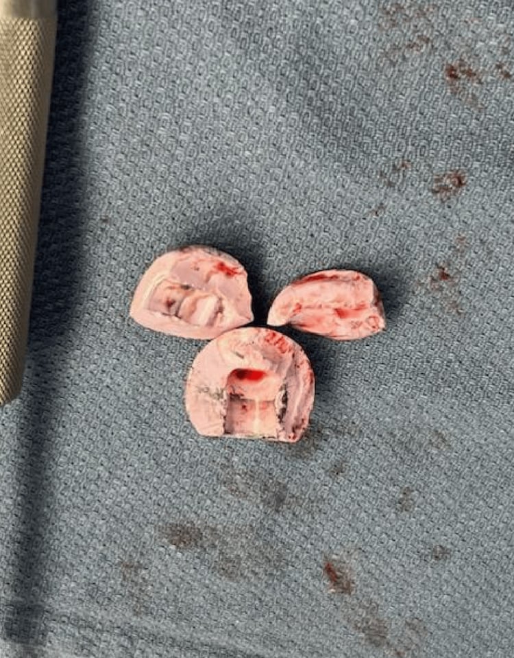 Three retrieved fragments of a fractured ceramic femoral head on an operative drape