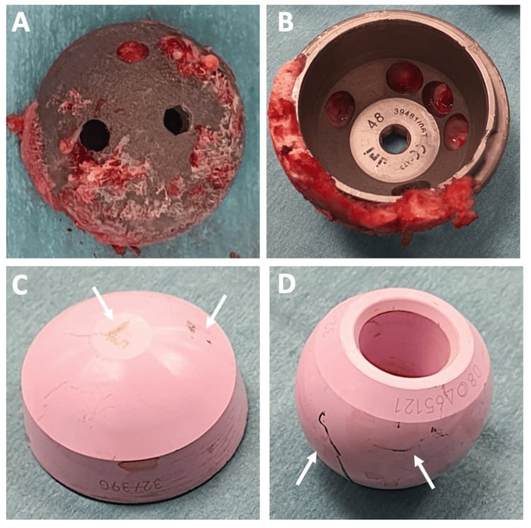 Four-panel photograph of retrieved metal acetabular and ceramic components with damage marked by white arrows