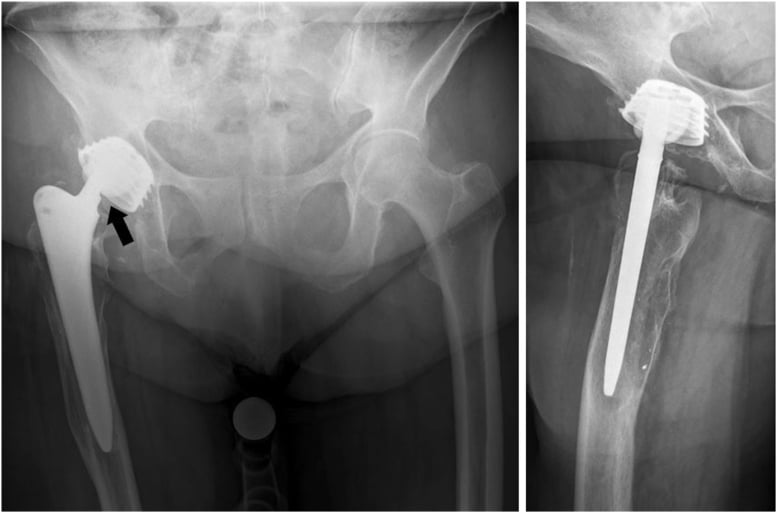 Anteroposterior and lateral hip radiographs showing ceramic liner fracture with asymmetric head position and displaced fragments