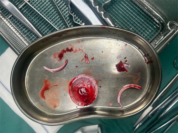 Intraoperative tray containing a fractured ceramic acetabular liner and multiple loose ceramic fragments