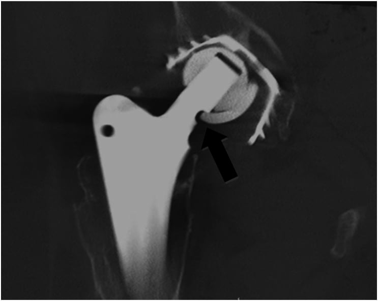 CT image of a total hip arthroplasty showing the femoral neck-bite sign marked by a black arrow