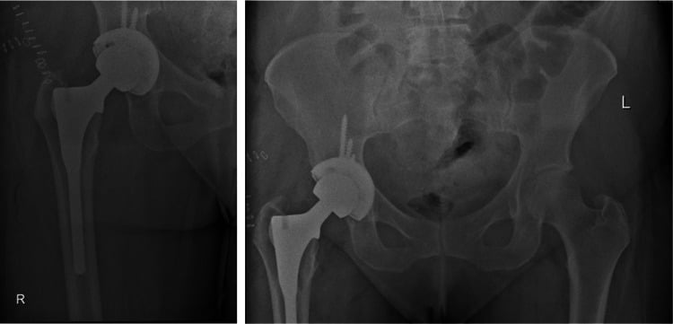 Focused hip and anteroposterior pelvis radiographs after revision ceramic-on-ceramic total hip arthroplasty