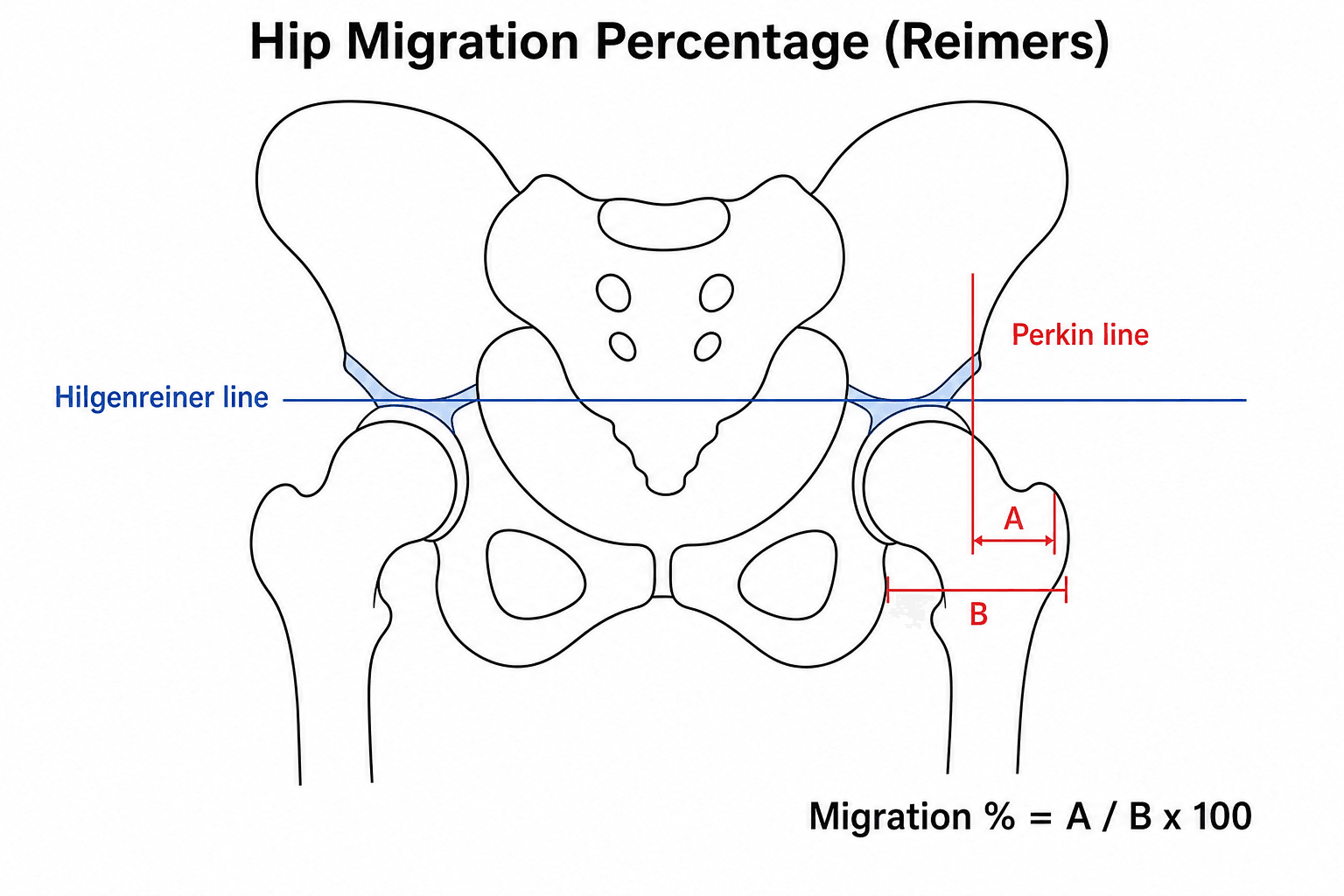 Diagram of Reimer's hip migration percentage measured on an AP pelvis with Hilgenreiner and Perkin lines.