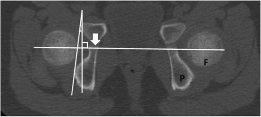 Axial CT through the proximal femur showing the femoral neck axis for anteversion measurement