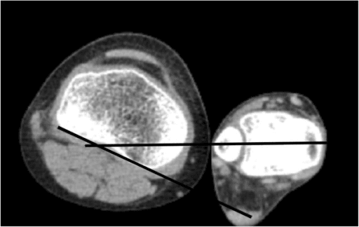 Axial CT through the distal femoral condyles for surgical anteversion measurement