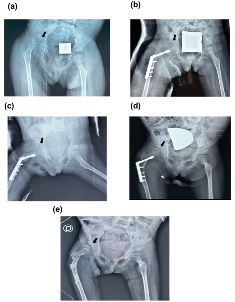 Five AP pelvis radiographs labelled (a) to (e) following one right hip: dislocated, plated after osteotomy in a cast, reduced, displaced again, then after hardware removal.