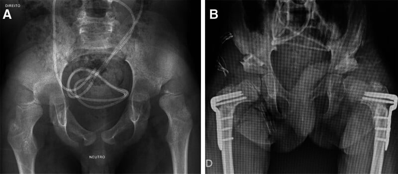 Two AP pelvis radiographs labelled A and B: A before surgery with both femoral heads high and lateral, B after bilateral plated femoral osteotomies and Dega acetabuloplasty.