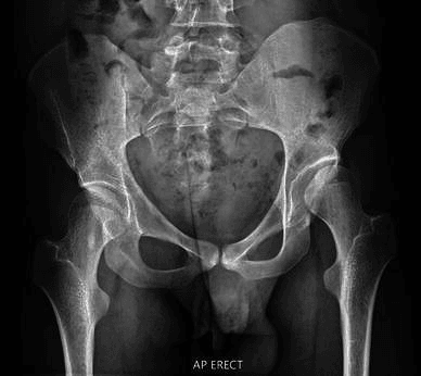 Cerebral palsy pelvis radiograph context