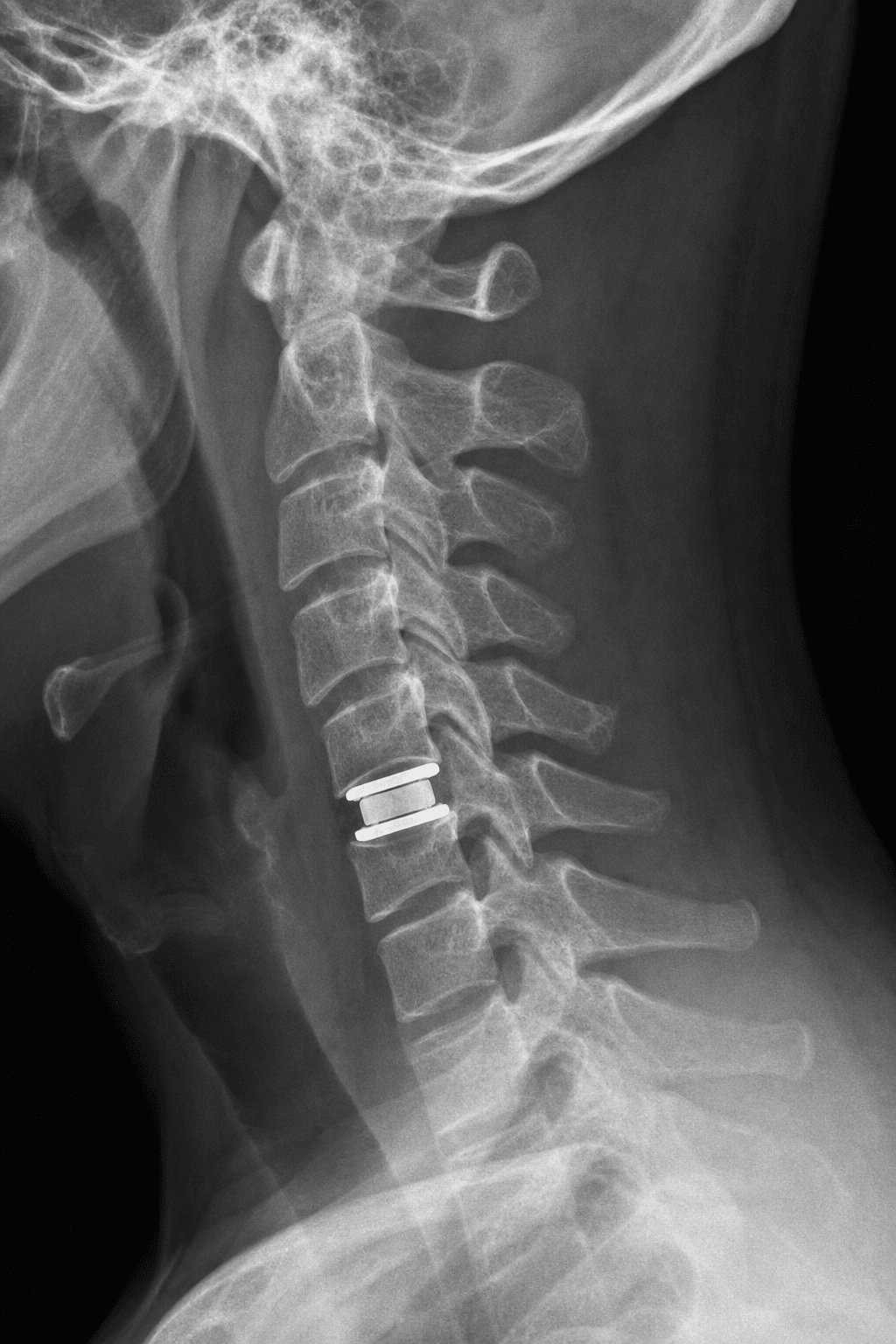 Lateral cervical radiograph showing an artificial disc prosthesis in a lower cervical disc space