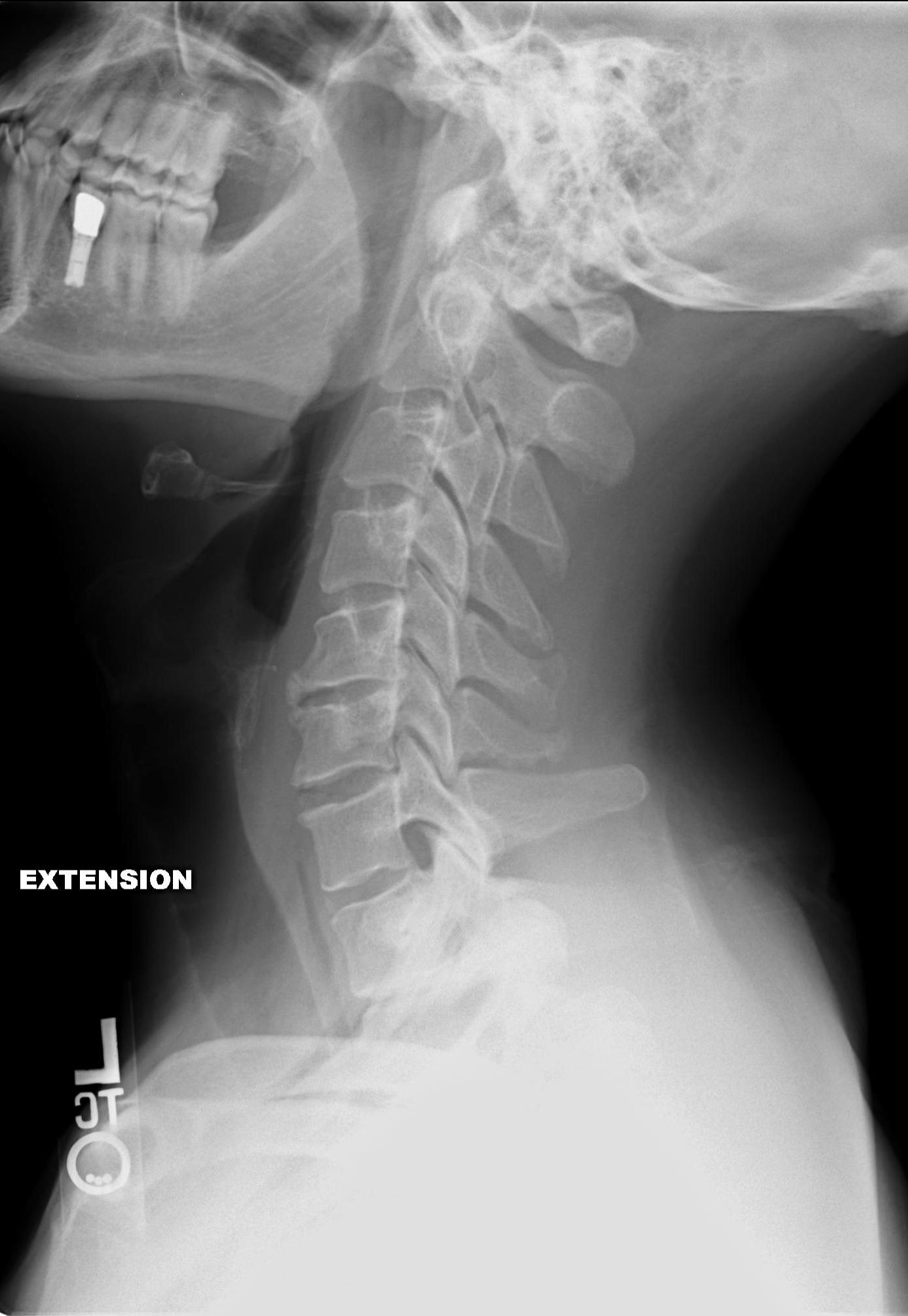 Lateral cervical spine radiograph in extension