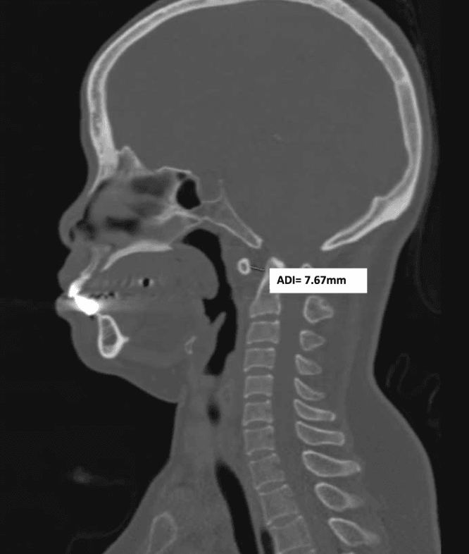 Sagittal CT of the craniovertebral junction with the atlantodental interval measured at 7.67mm