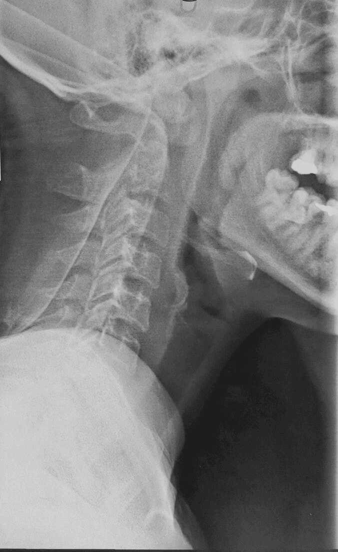 Lateral cervical radiograph from a report of atlantoaxial dislocation in cervical tuberculous spondylodiscitis