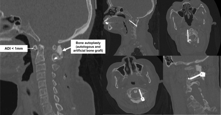 Postoperative sagittal CT labelled ADI under 1mm and bone autoplasty, with further CT reformats showing the screw trajectories