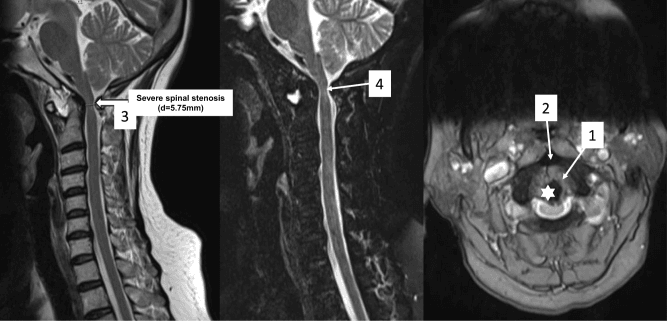 Two sagittal MRI images and one axial MRI image of the craniovertebral junction, the canal labelled severe spinal stenosis, d = 5.75mm