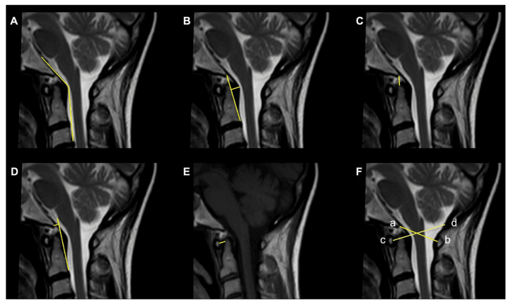 Six sagittal MRI panels (A-F) of the craniovertebral junction with measurement lines drawn in yellow, panel F with points labelled a to d