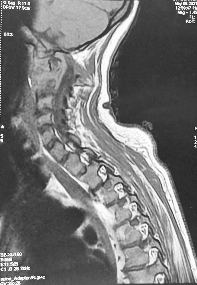 Sagittal MRI of the cervical spine and cord from the same report of destructive atlantoaxial disease