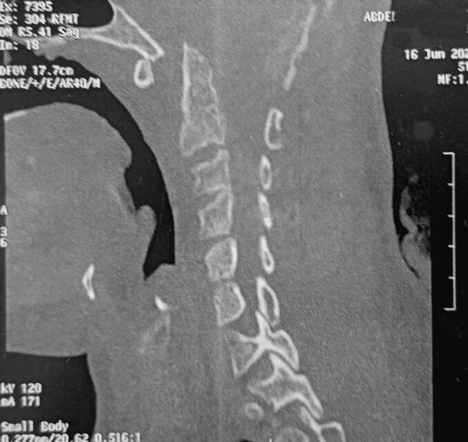 Sagittal CT showing a wide gap between the anterior arch of C1 and an irregular odontoid