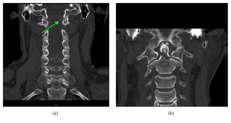 Coronal CT: in (a) an arrow marks an occipital condyle avulsion; in (b) the occiput-C1 and C1-C2 joints are reduced