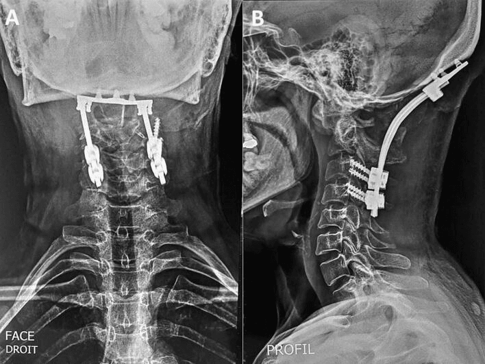 AP (A) and lateral (B) radiographs showing posterior occipitocervical instrumentation
