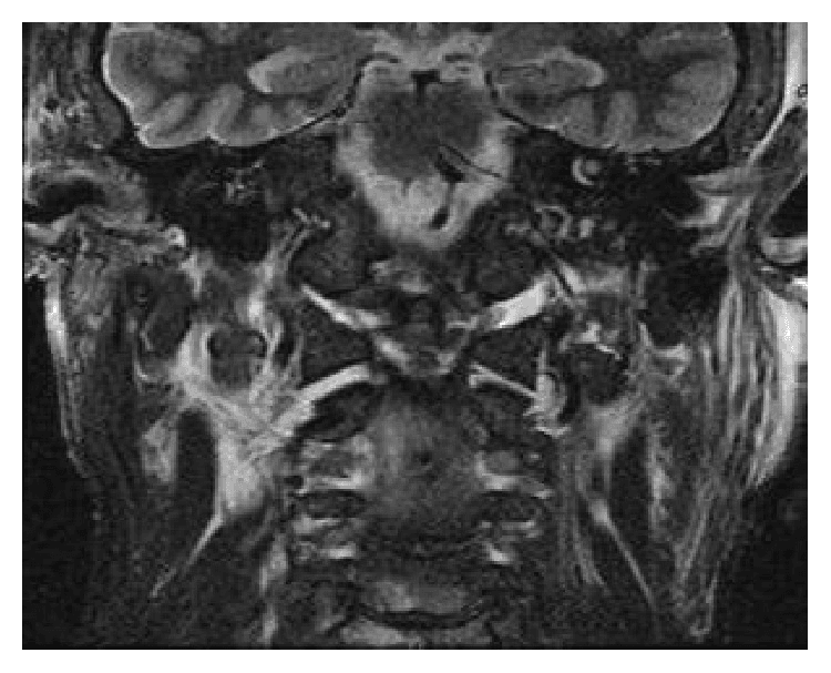 Coronal MRI of the craniocervical junction with extensive high-signal soft-tissue oedema