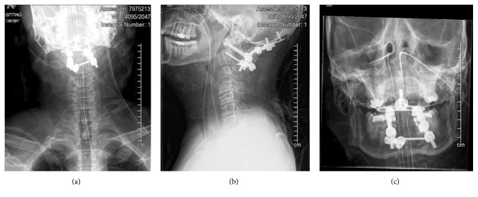 Postoperative radiographs (a-c) showing a posterior occipitocervical construct