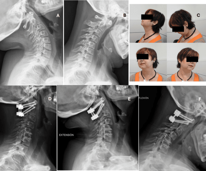 Lateral cervical radiographs (A, B), clinical photographs of head and neck position (C) and lateral radiographs after posterior upper cervical screw fixation (D), with extension (E) and flexion (F) films labelled
