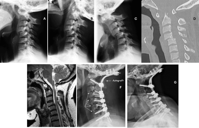 Lateral radiographs (A-C), sagittal CT (D) and sagittal MRI (E) of rheumatoid cervical disease, then lateral radiographs after long posterior occipitocervical reconstruction (F, G) with the autograft labelled