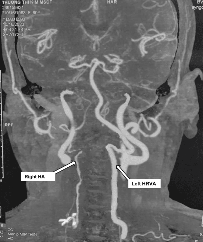 CT angiogram maximum-intensity projection with the vertebral arteries labelled Right HA and Left HRVA